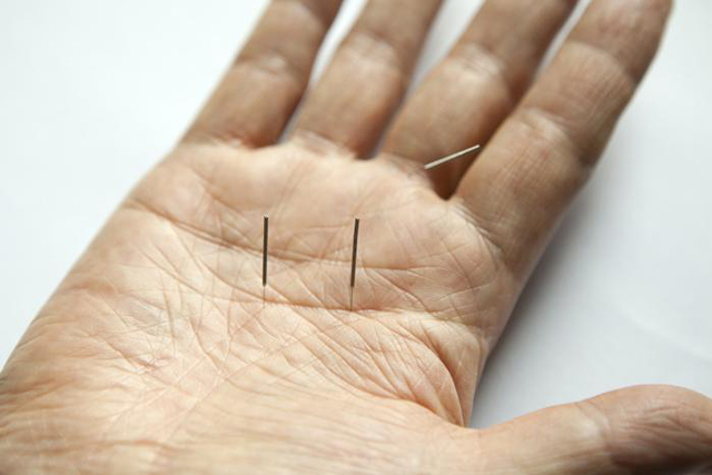 Kako vam lahko akupunktura pomaga pri teku